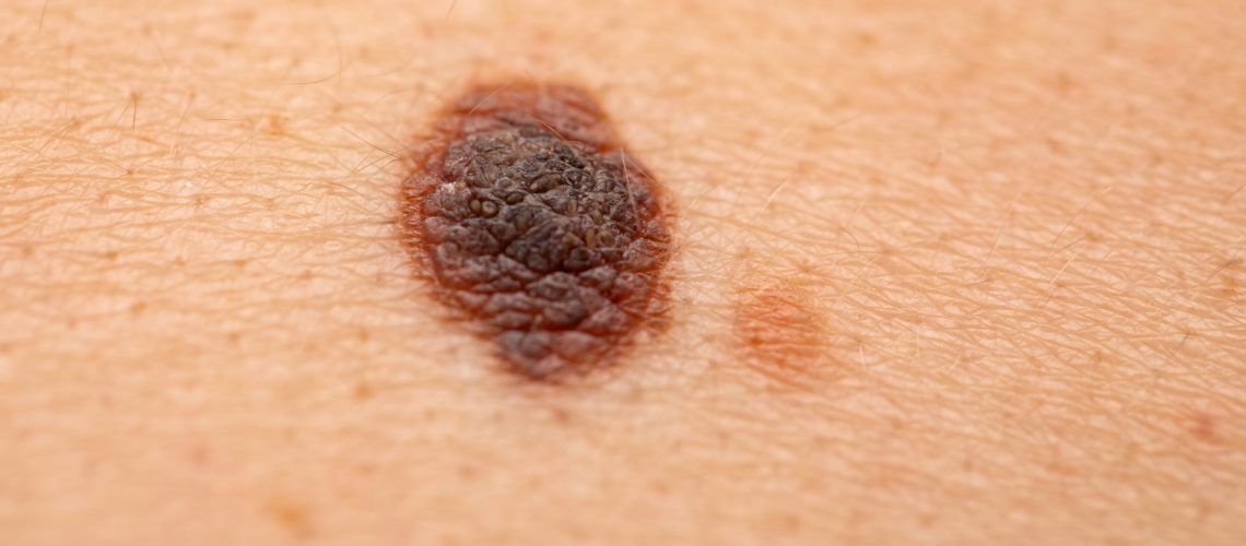 melanoma