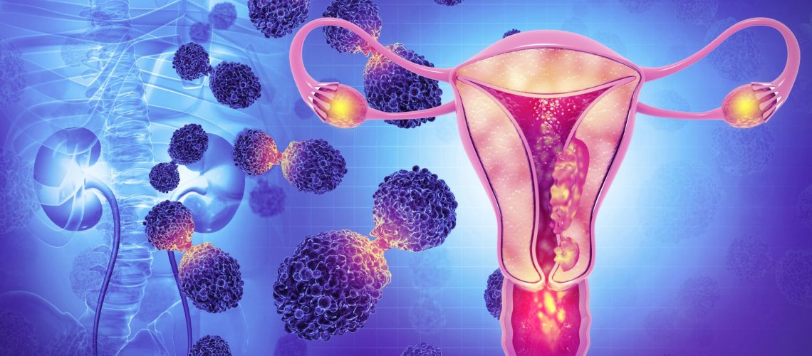 Câncer Ginecológico