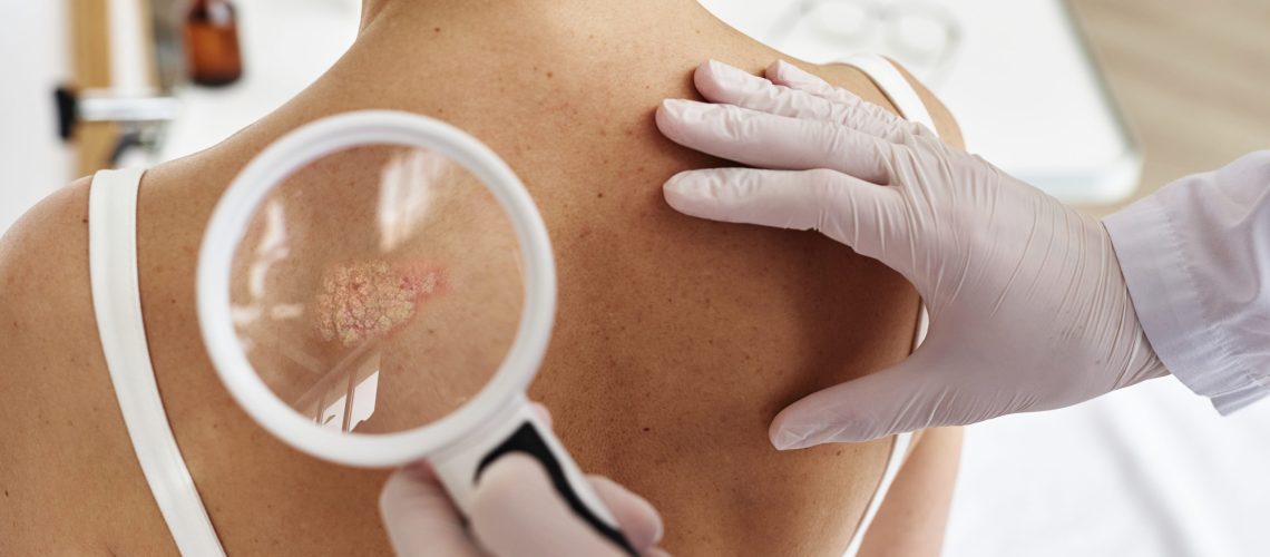 Câncer de Pele