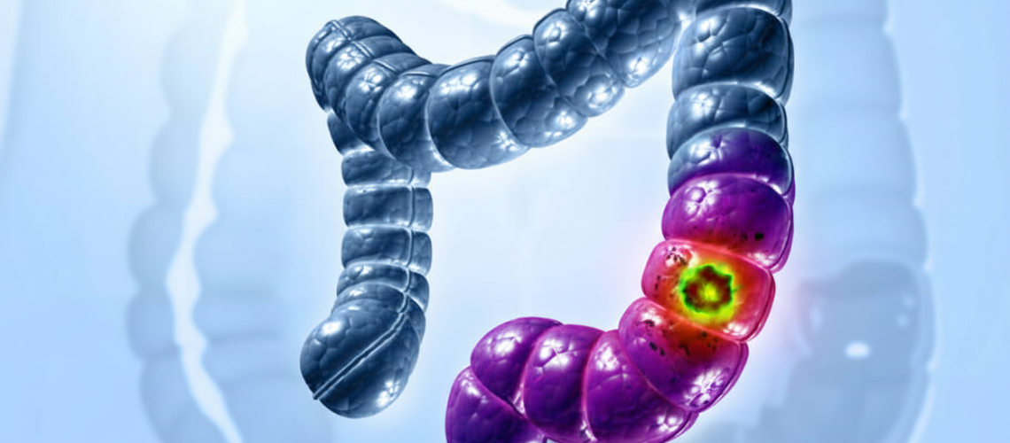 Câncer Colorretal em Mulheres_ Sintomas Iniciais e Importância do Diagnóstico Precoce