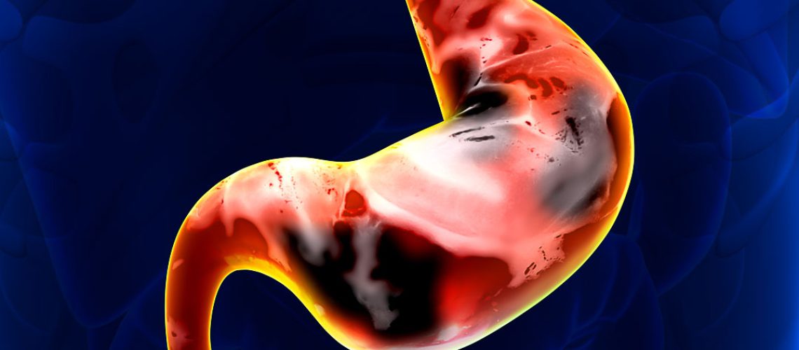 Câncer de Estômago Causas, Sintomas e Tratamento