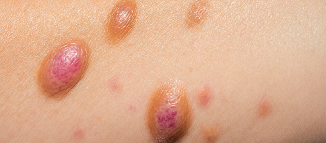 Melanoma Amelanótico Desafios no Diagnóstico e Importância da Detecção Precoce