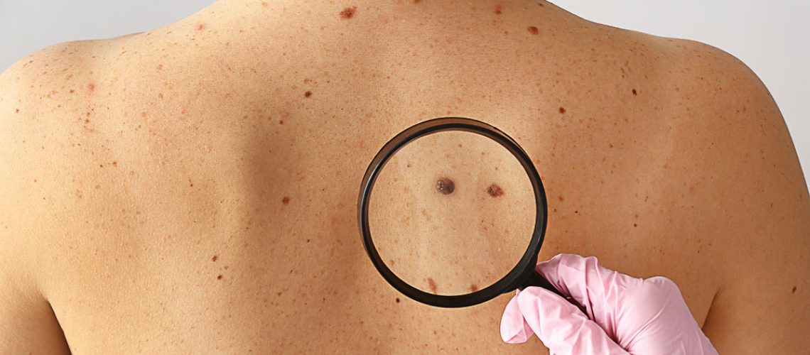 Dermatologist examining moles of patient in clinic