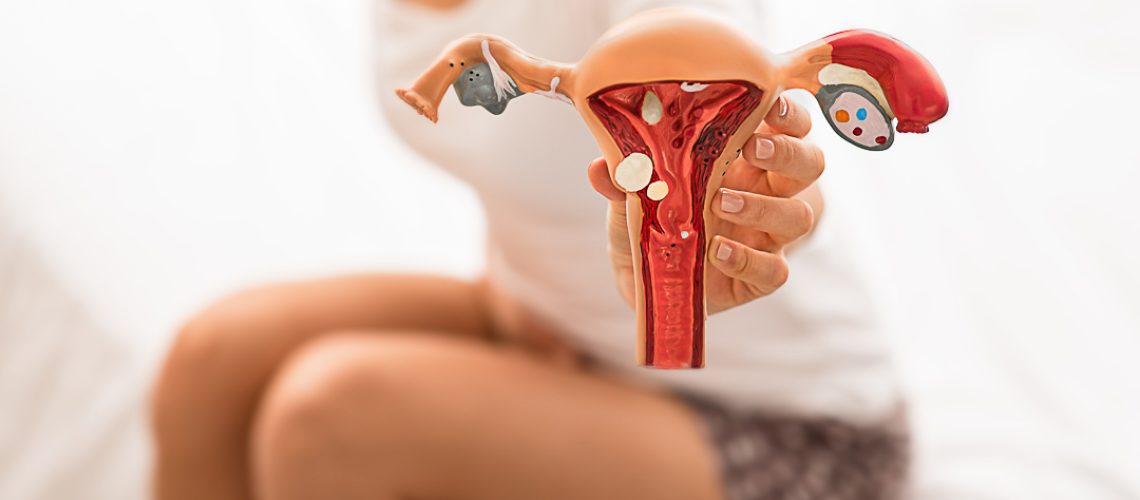 Nódulos nos ovários Principais causas e tratamentos