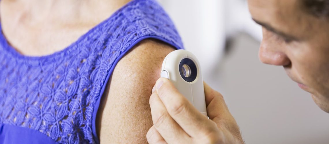 câncer de pele melanoma