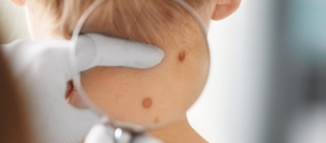 carcinoma basocelular