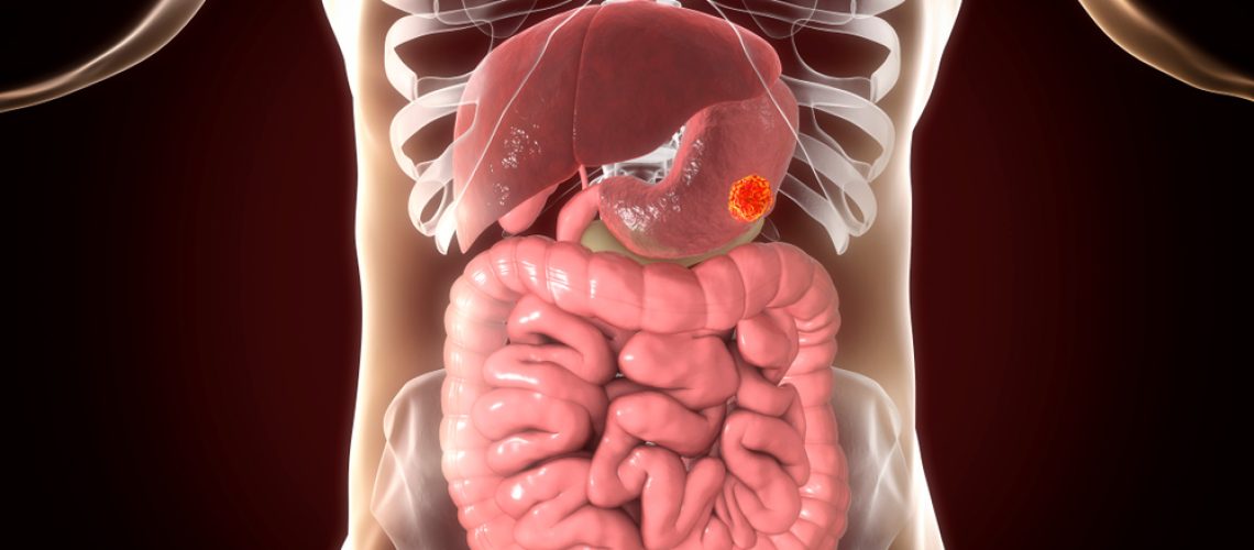 câncer de estômago